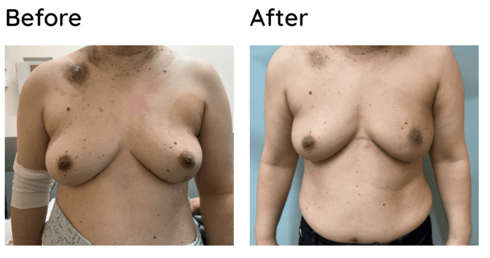 Breast Reconstruction after Mastectomy, Implant-Based