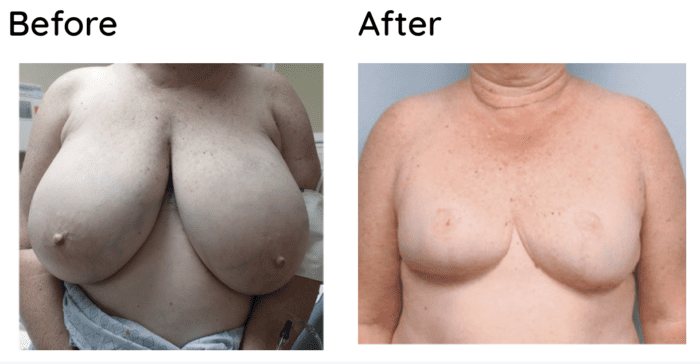 Reconstruction after a bilateral mastectomy - Breast Cancer Survivor Video