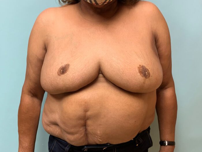 breast reduction surgeory