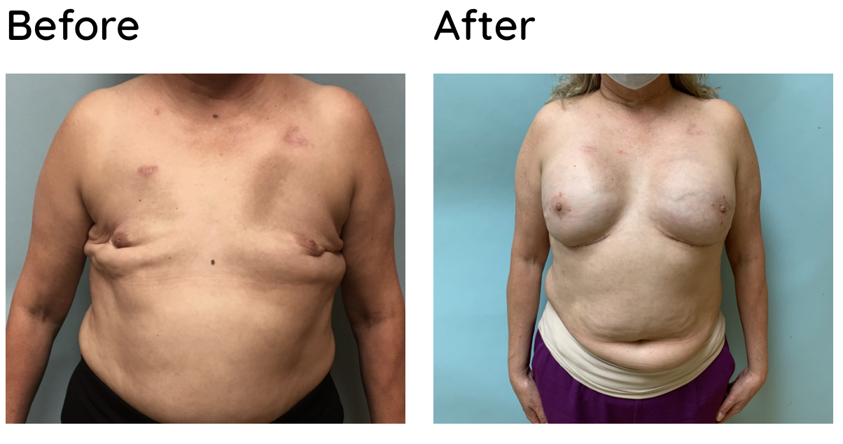 To have breast reconstruction surgery or remain flat?