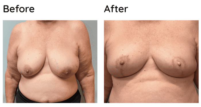 Nipple Reconstruction