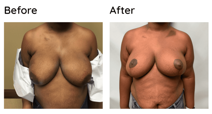 breast reduction surgeory
