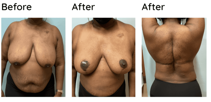 reast Reconstruction after Mastectomy, Flap-Based