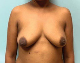 Mastectomy with Implant Reconstruction