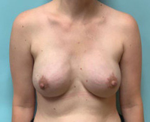 Mastectomy with Implant reconstruction