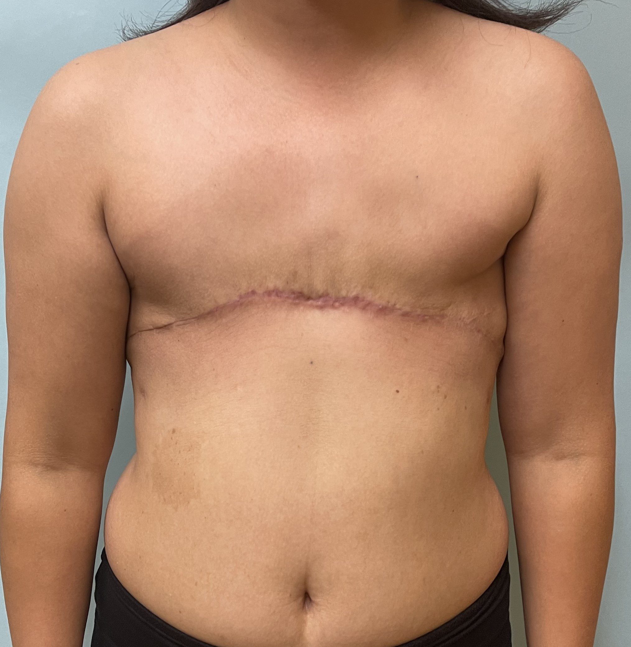 mastectomy photos without reconstruction - bilateral