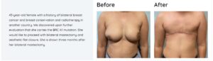 Before and after images of a woman undergoing aesthetic flat closure