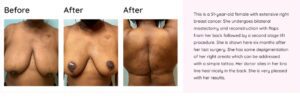 Woman before and after breast cancer surgery with a back flap