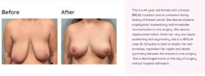 Woman with breast cancer before and after breast cancer surgery and reconstruction with breast implants