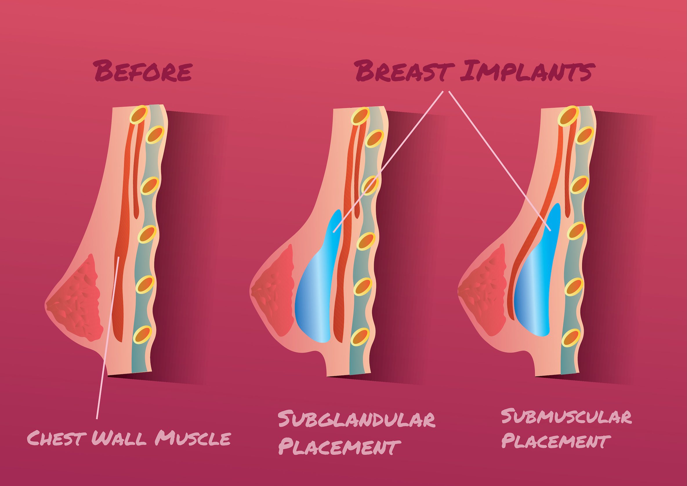 Breast Implant placement